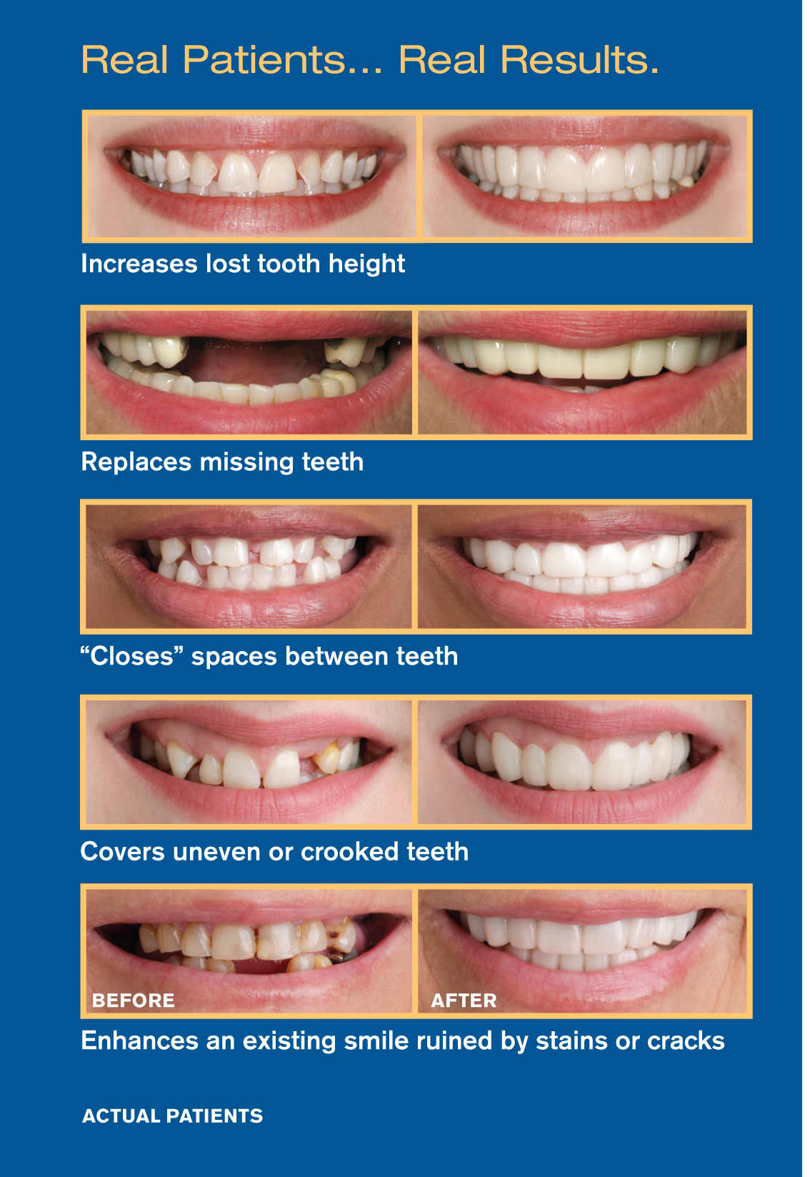 Lumineers and snap on smile dentist in suwanee ga